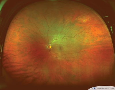 Optomap retinal imaging