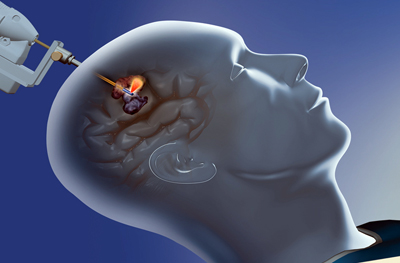 说明: Brainwave: Monteris's NeuroBlate System offers comprehensive laser ablation.